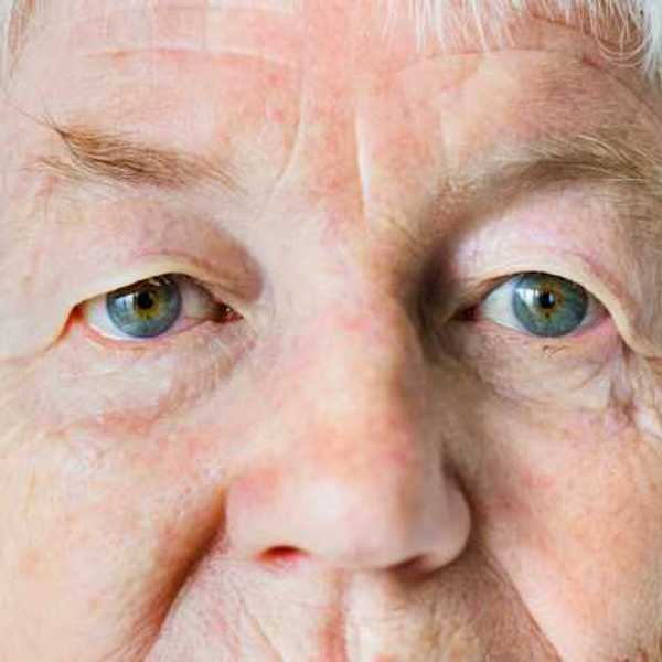 A closeup of an older person's face including their eyes