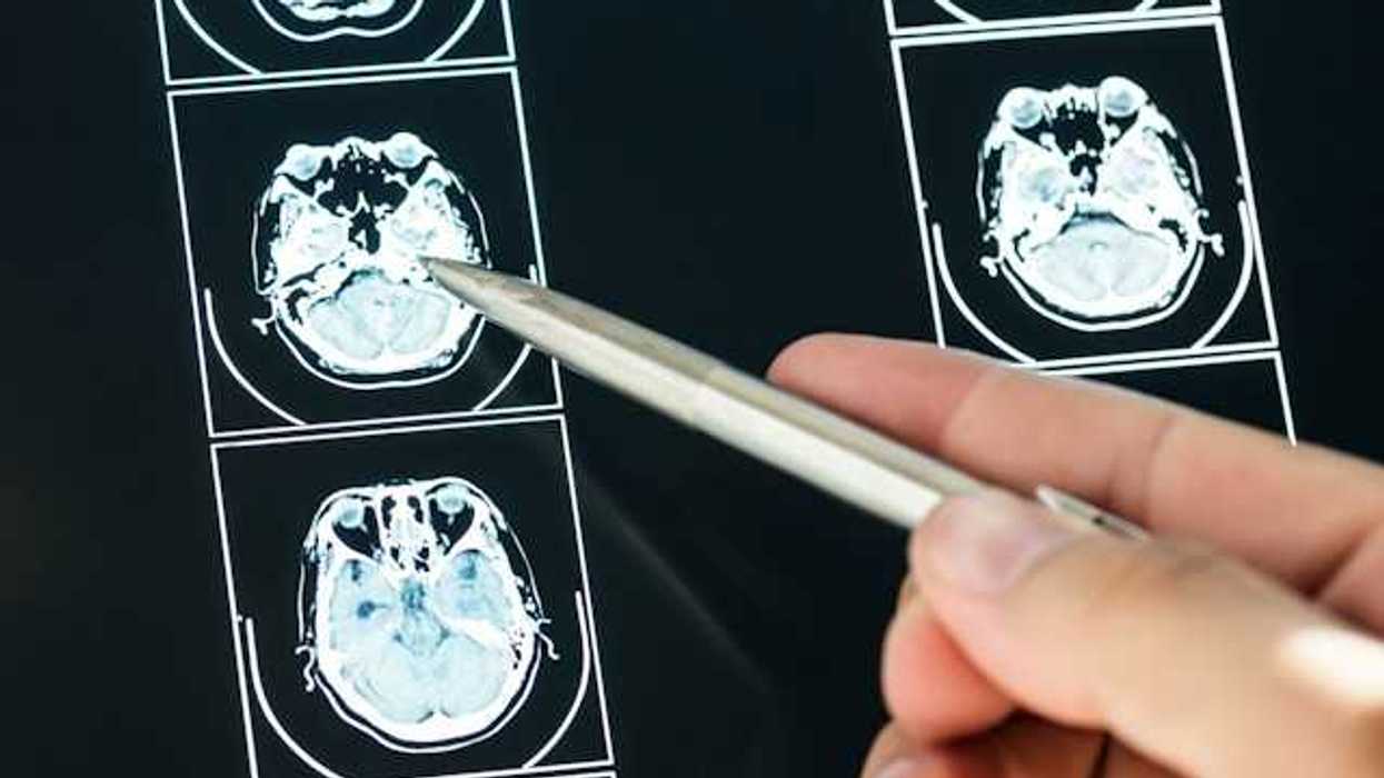 A person pointing a silver pen at xrays of a brain