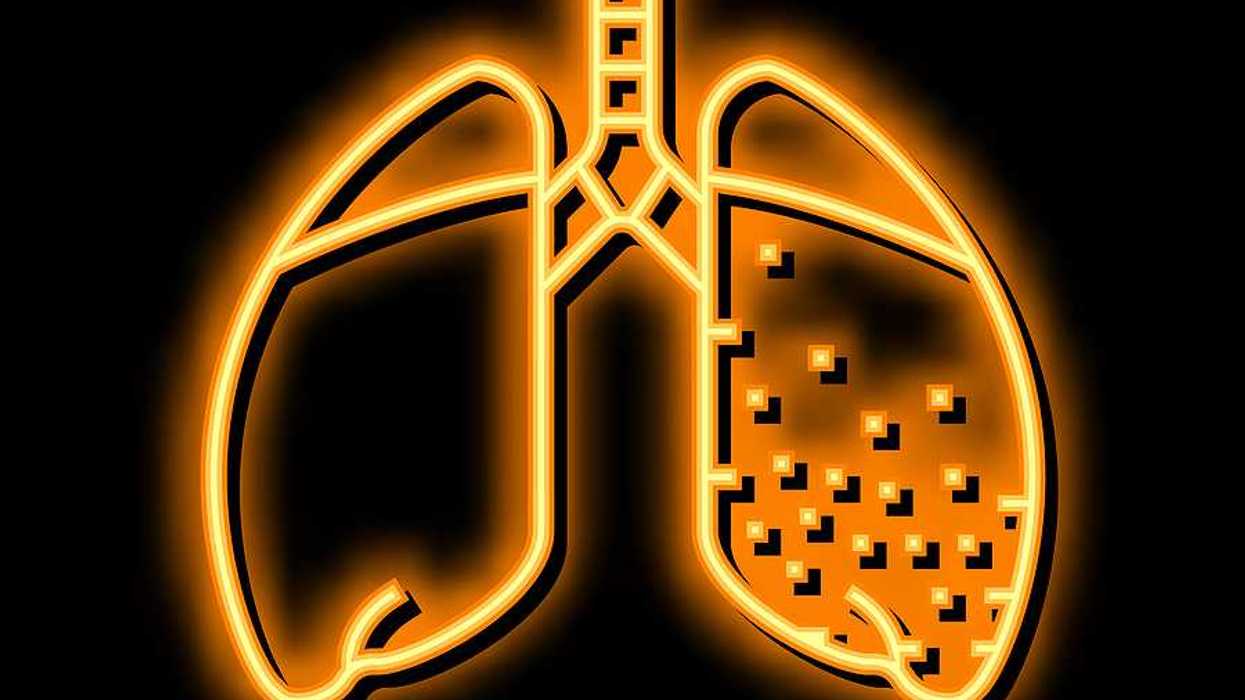 An illustration of a set of lungs with dots representing silicosis in one side