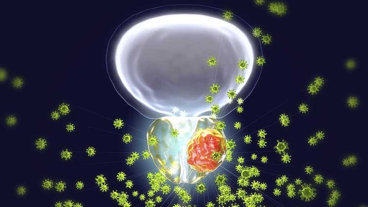 An illustration of prostate cancer
