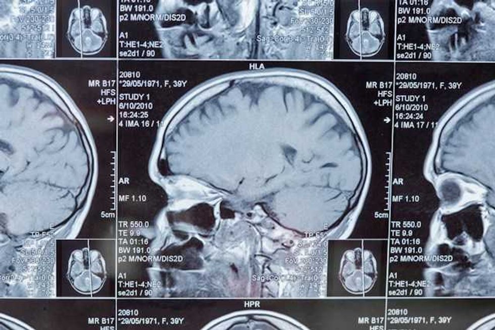 Climate change is putting Europe’s brain health at risk