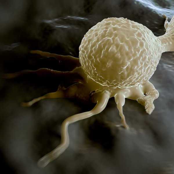 Dividing breast cancer cell in the telophase stage of cell division.