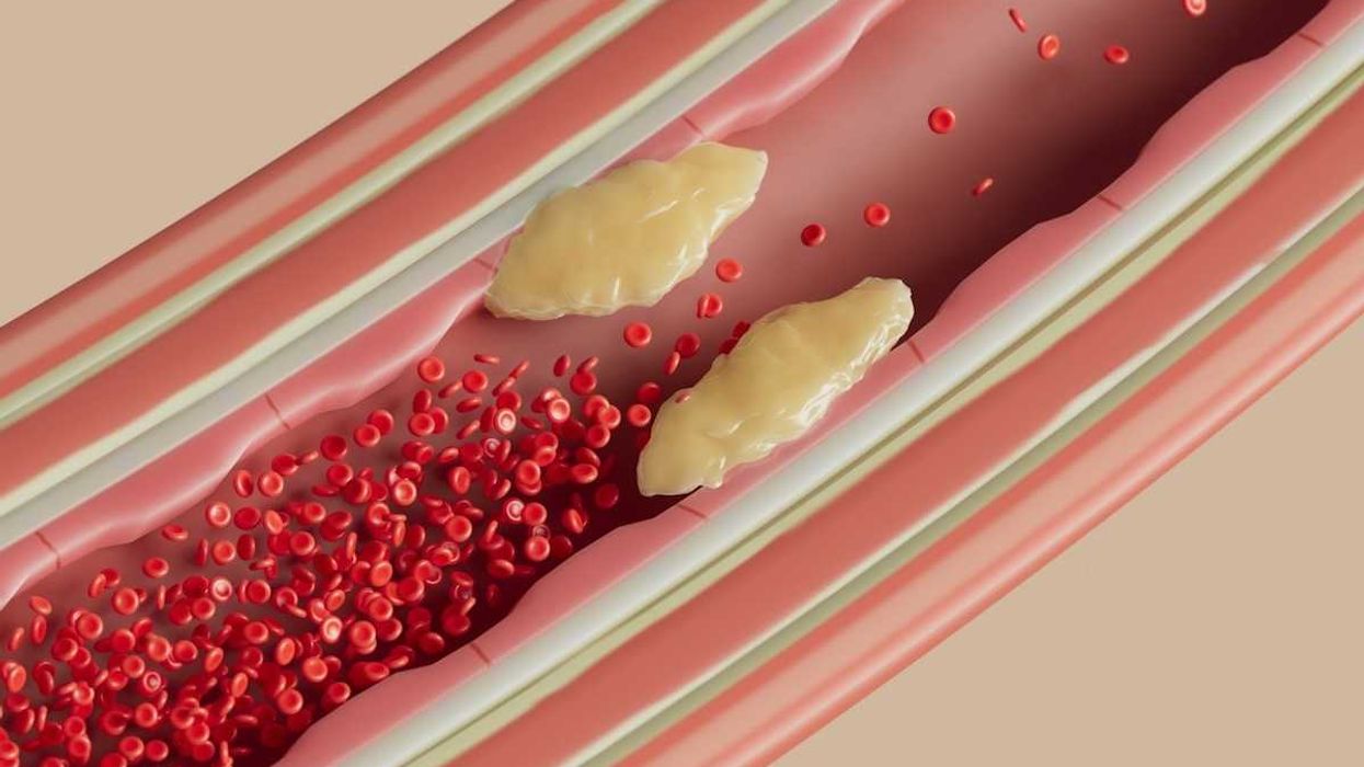 illustration of plaque buildup in arterial wall restricting blood flow