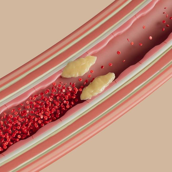 illustration of plaque buildup in arterial wall restricting blood flow