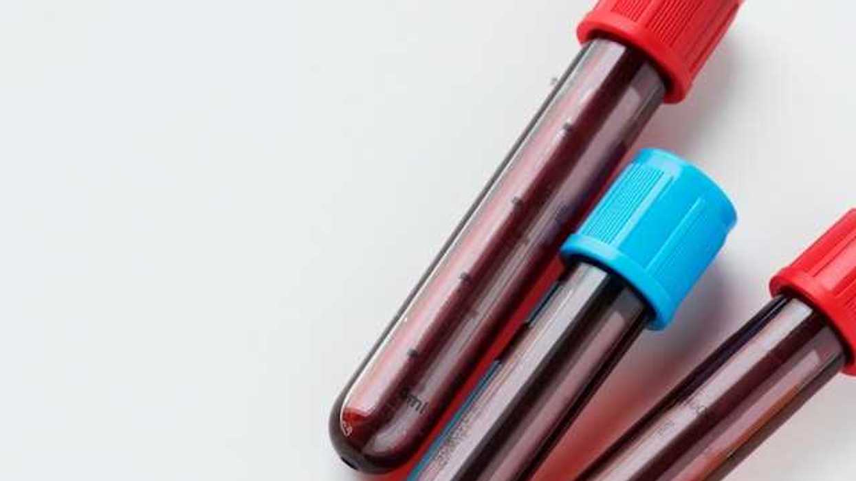 Three small vials of blood two with red caps and one with a blue cap