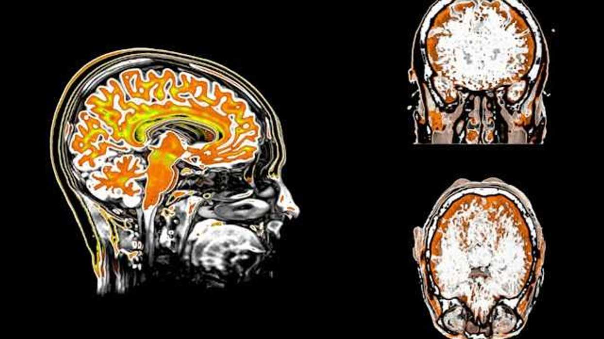 Views of a human brain scan, or MRI